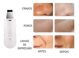 Beauty Peeling Ultrassônico - Limpeza Facial